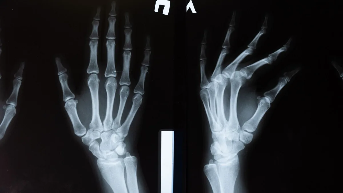 High-resolution x-ray image showing the intricate anatomy of human hands. — Illustration accompanying coverage of the cagrilintide bone density trial comparing cagrilintide, semaglutide and CagriSema